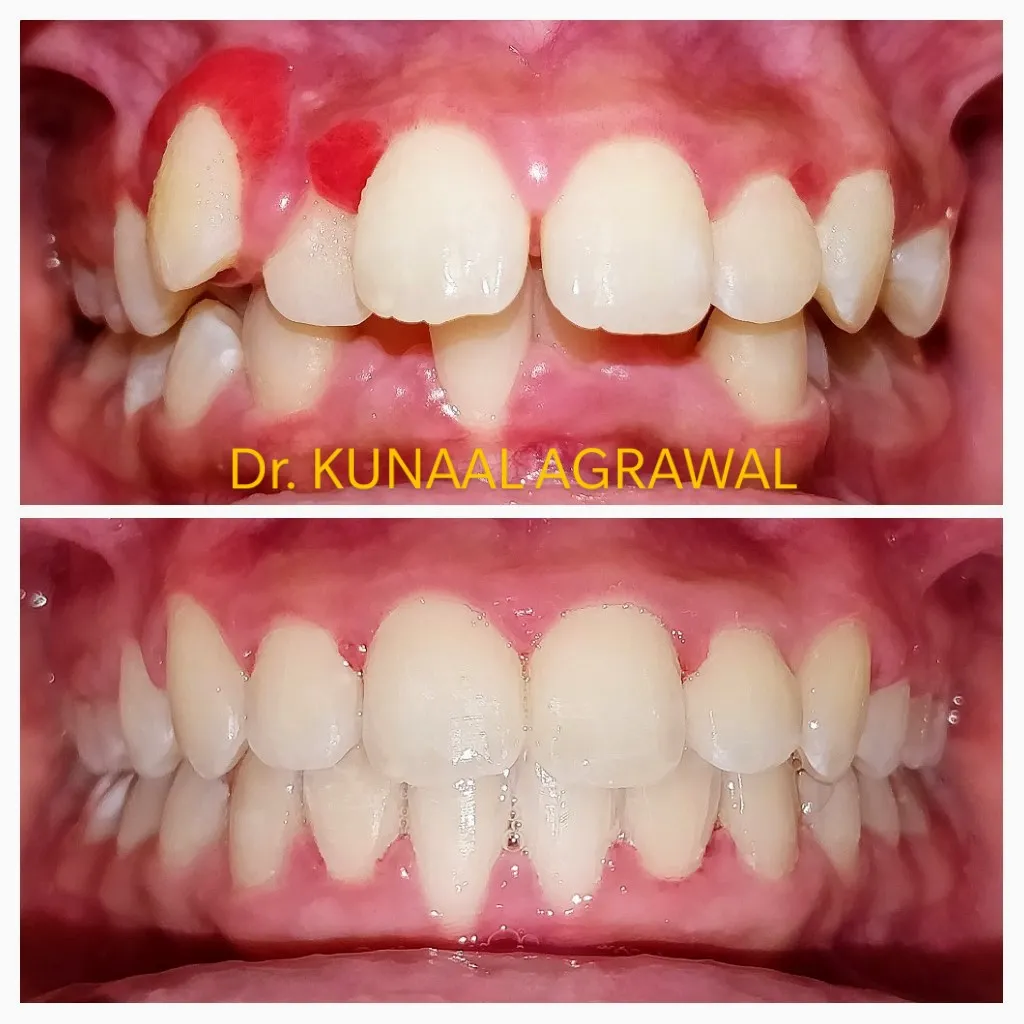 braces before and after bhopal 12